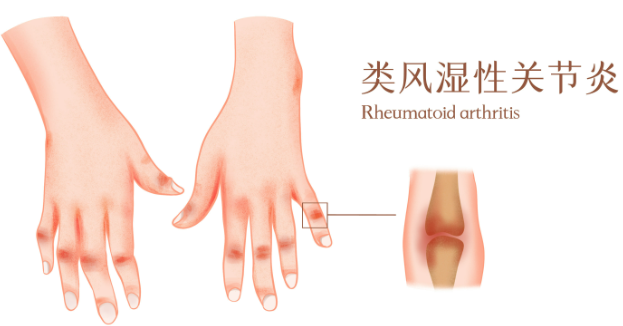 邵陽創(chuàng)傷骨科,邵陽風濕病區(qū),邵陽骨質(zhì)增生,邵陽關(guān)節(jié)病區(qū),邵陽頸椎病區(qū)